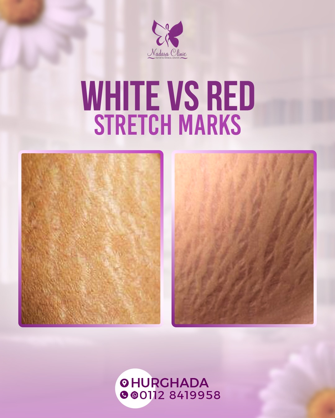 White and red stretch marks and the difference between them in Hurghada
